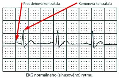 normálne EKG