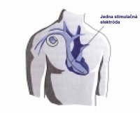 stimulacna-elektroda-1