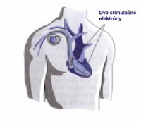 stimulacna-elektroda-2
